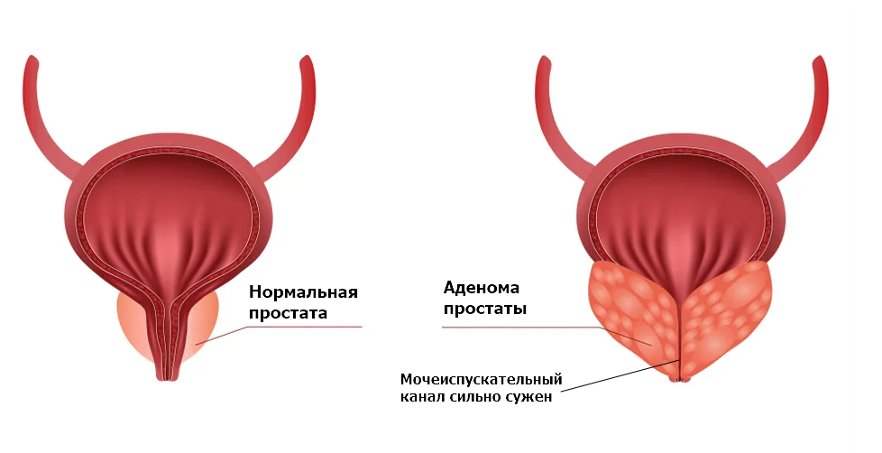 нормальная простата и аденома