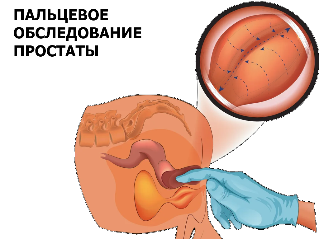 пальцевое обследование простаты