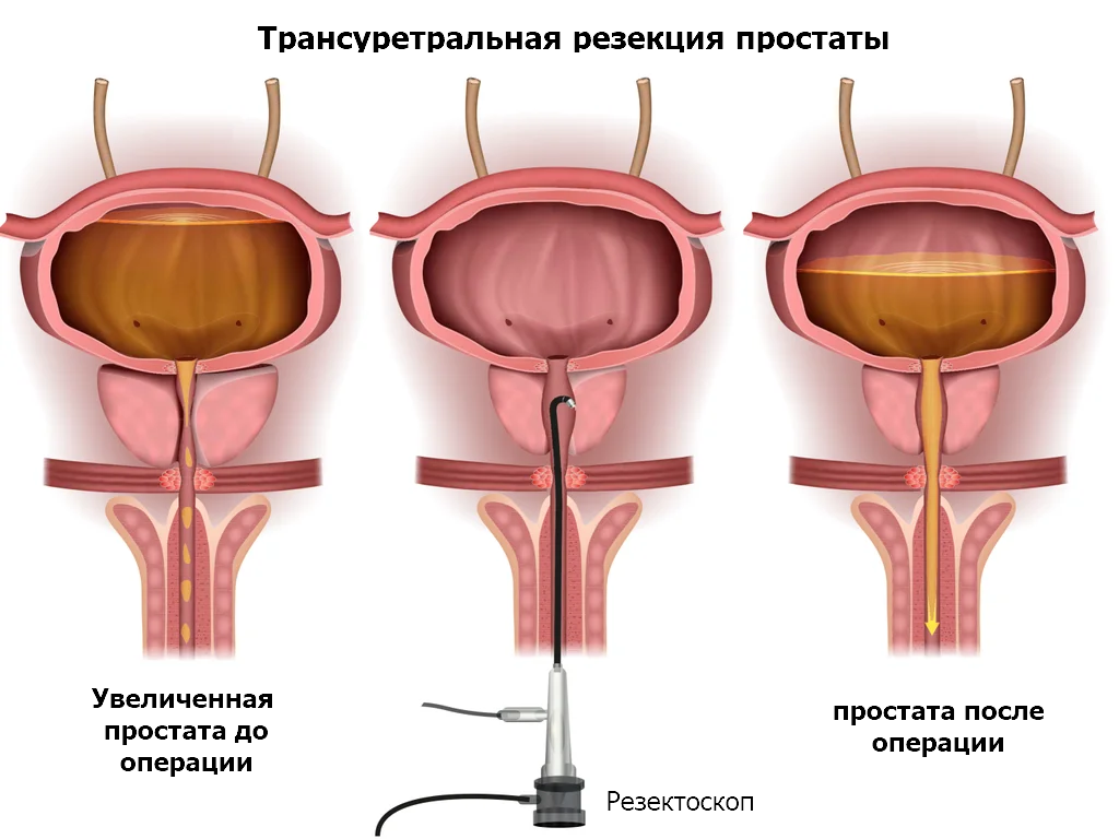 пальцевое обследование простаты