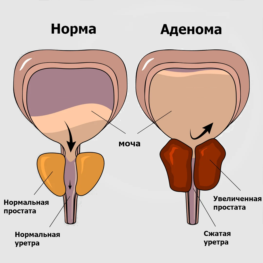 остаток мочи при аденоме