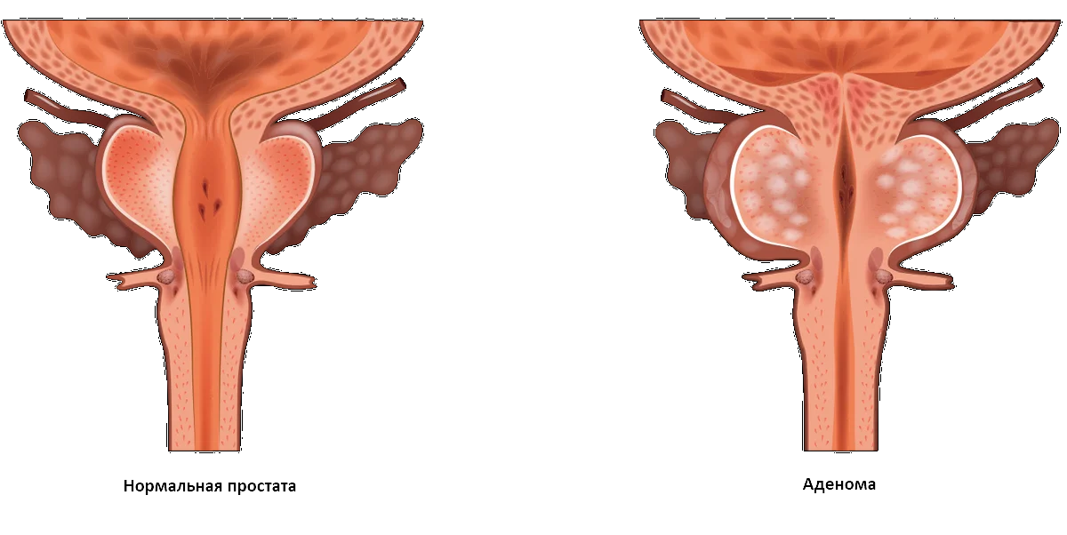 здоровая простата и аденома