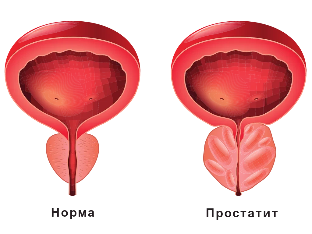 Что такое простатит